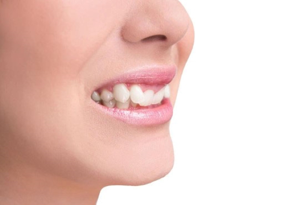 chỉnh răng mọc lệch bao nhiêu tiền