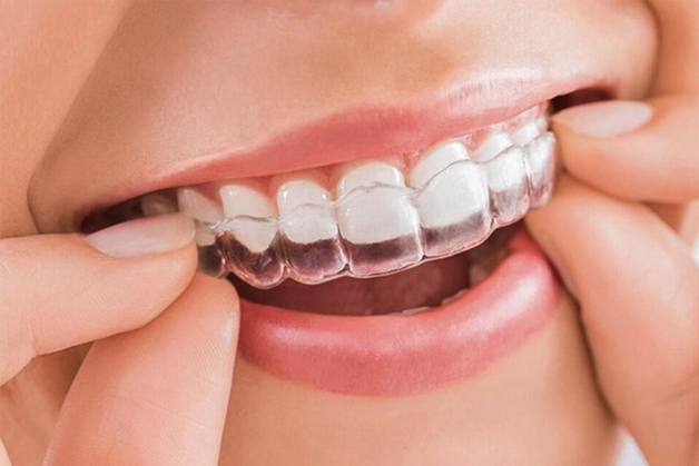 chỉnh răng mọc lệch bằng phương pháp chỉnh nha