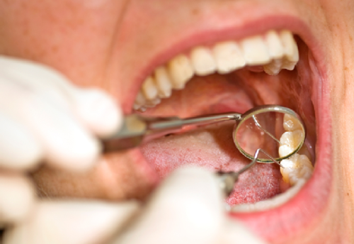 Điều trị lấy tủy răng là một biện pháp tối ưu giúp giảm đau.