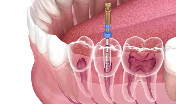 Mức giá của điều trị tủy sẽ phụ thuộc và mức độ nặng nhẹ của vấn đề tủy răng đang gặp phải