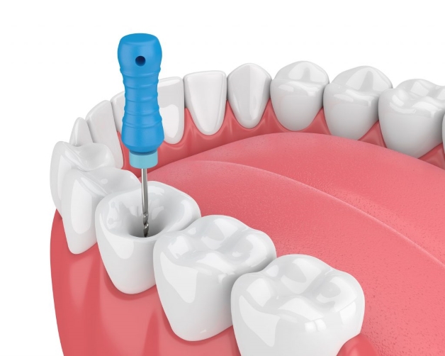 điều trị tủy răng chưa đóng chóp