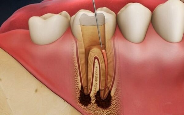 Nguyên nhân điều trị tủy răng lại là gì?