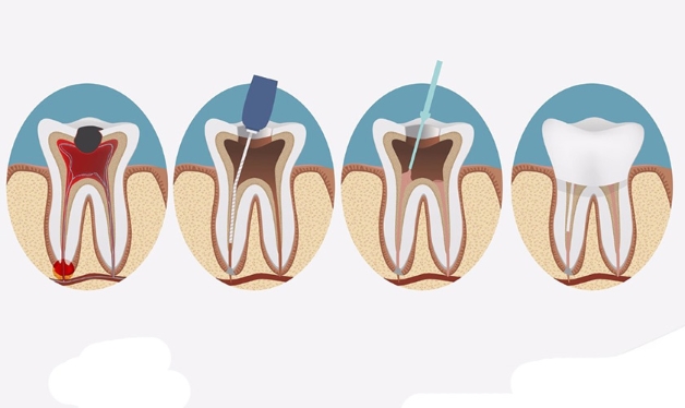 Tiêu chí điều trị tủy răng ở đâu tốt
