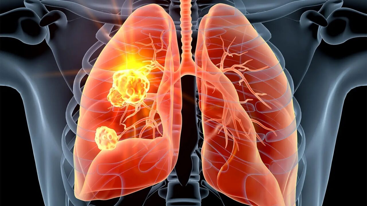 Tìm hiểu các cách chữa bệnh ung thư phổi không tế bào nhỏ