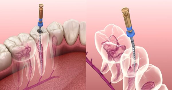 Giá điều trị viêm tủy răng theo từng tình huống
