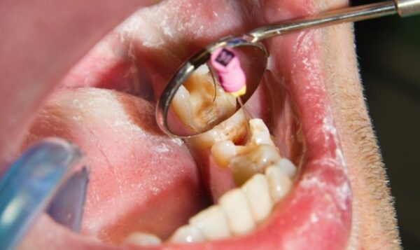 Điều trị viêm tủy răng bao nhiêu tiền vậy