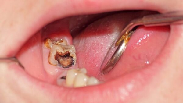 Lưu ý sau khi điều trị viêm tủy răng có hồi phục