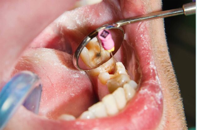 Sâu răng là một trong những nguyên nhân phổ biến nhất gây viêm tủy răng.