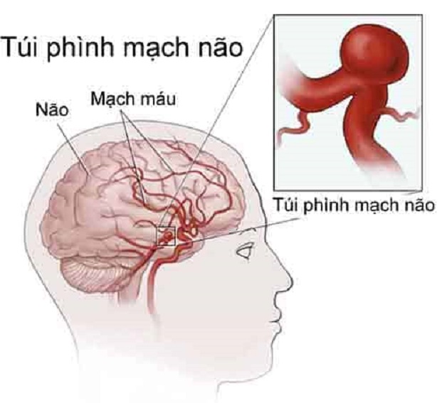 Đột quỵ do phình quá mức mạch máu não
