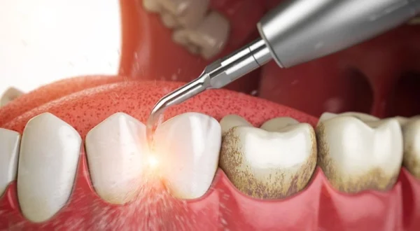 Nếu không dùng đúng cách, những loại máy lấy cao răng có thể gây ảnh hưởng không tốt