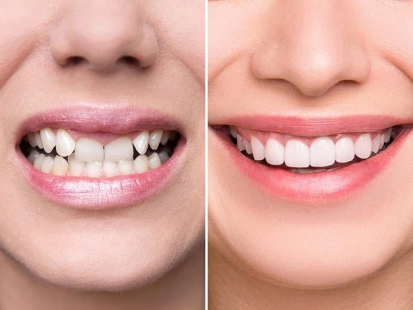 Có rất nhiều mức giá khác nhau ứng với những loại mão sứ khác nhau
