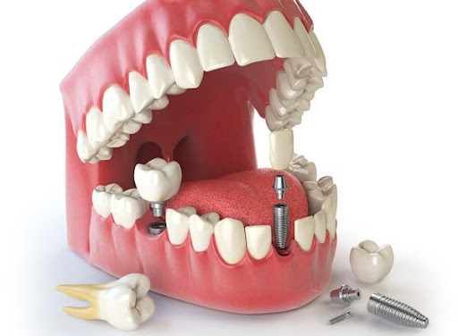 Tùy vào lựa chọn của khách hàng mà mức giá cấy ghép Implant bao nhiêu
