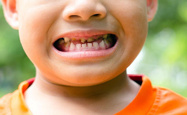 Tình trạng cần xem xét điều trị viêm tủy răng sữa ở trẻ