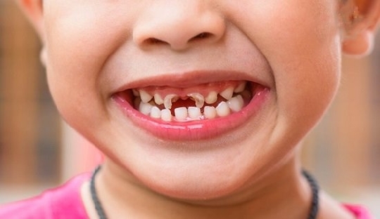 Các loại viêm tủy răng sữa thường gặp ở trẻ