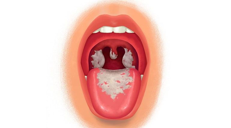 Nguyên nhân bệnh bạch hầu được xác định bởi ngoại độc tố tiết ra từ vi khuẩn Corynebacterium