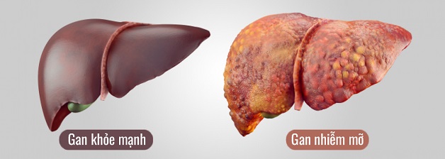 Gan nhiễm mỡ là tình trạng mỡ trong gan tích tụ quá nhiều