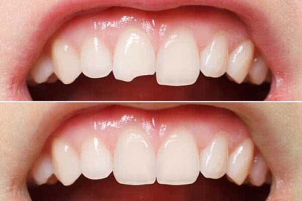 Ưu điểm của việc hàn răng cửa