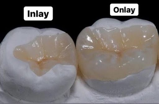 Tìm hiểu hàn răng Inlay/Onlay là gì?