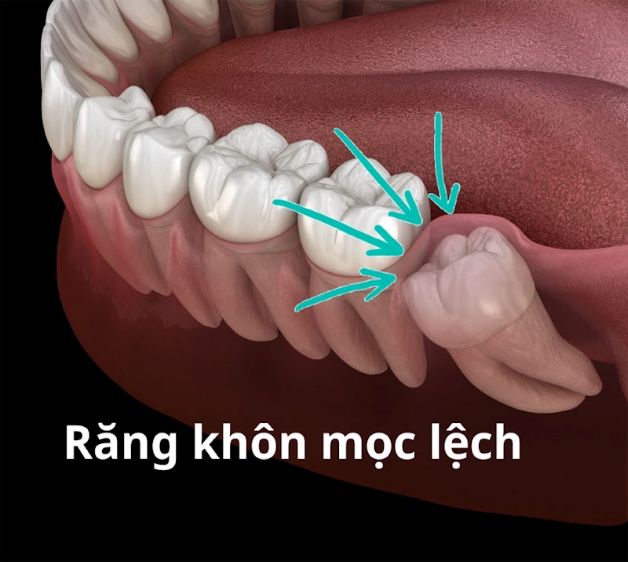 răng khôn