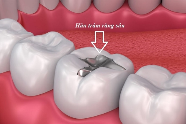 ưu điểm hàn răng và bọc răng