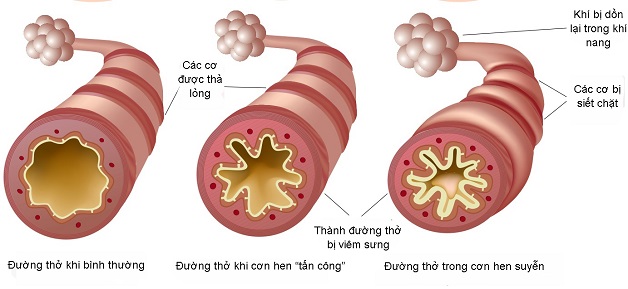 Hen phế quản là bệnh lý đường hô hấp