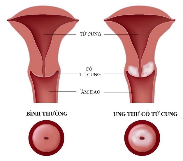 sàng lọc ung thư cổ tử cung