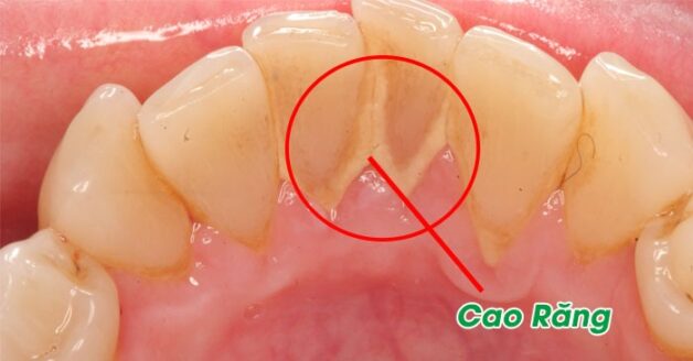 Kem đánh răng tẩy cao răng nào hiệu quả