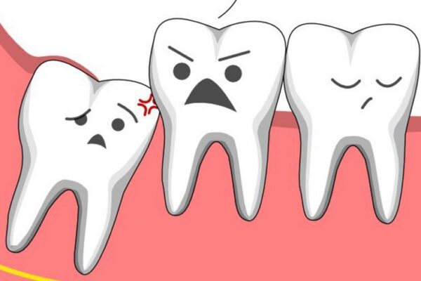 khi nào cần nhổ răng khôn