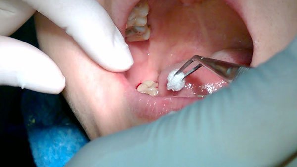 Cần tìm nguyên nhân khiến răng khôn bị đau và xứ trí