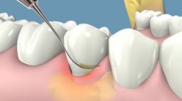 Lấy cao răng giúp bảo vệ răng miệng, tránh bệnh lý cho mọi người