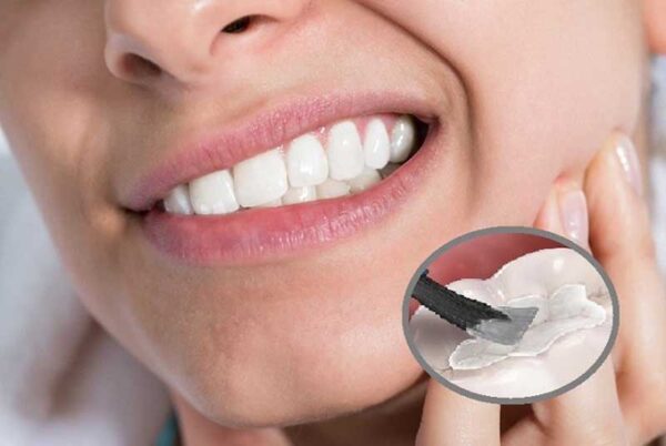 Trám răng sâu bền trong bao lâu?
