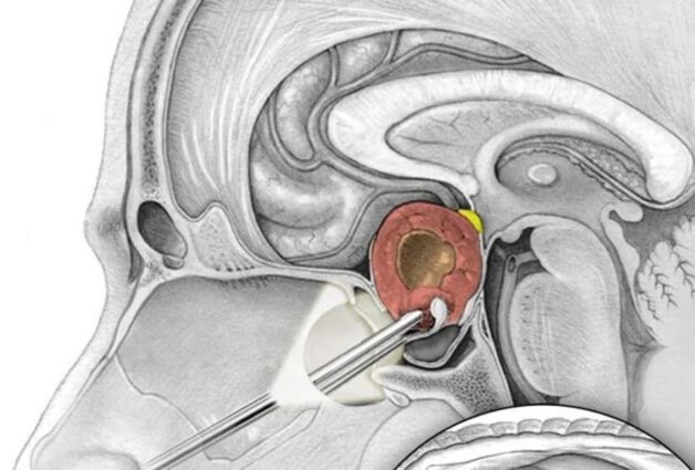 Những người từ 30 – 40 tuổi là nhóm đối tượng có tỷ lệ mắc bệnh u tuyến yên cao hơn.