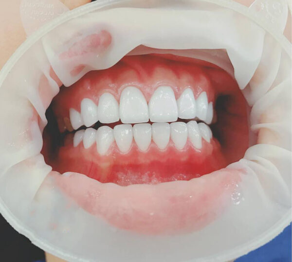 lựa chọn răng sứ phù hợp với nhu cầu và chi phí