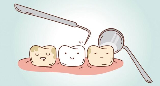 Lấy cao răng bằng công nghệ mới như thế nào