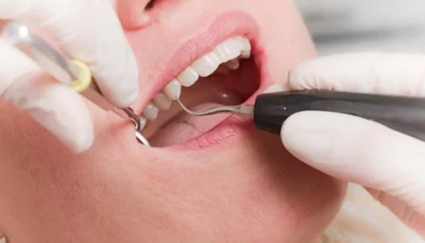 Lấy cao răng bằng máy siêu âm giúp việc lấy cao răng trở nên đơn giản hơn