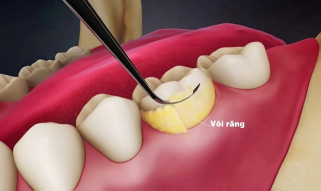 Tiêu chí chọn nha khoa lấy cao răng uy tín