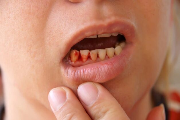 Lấy vôi răng chống chỉ định trong 1 số trường hợp
