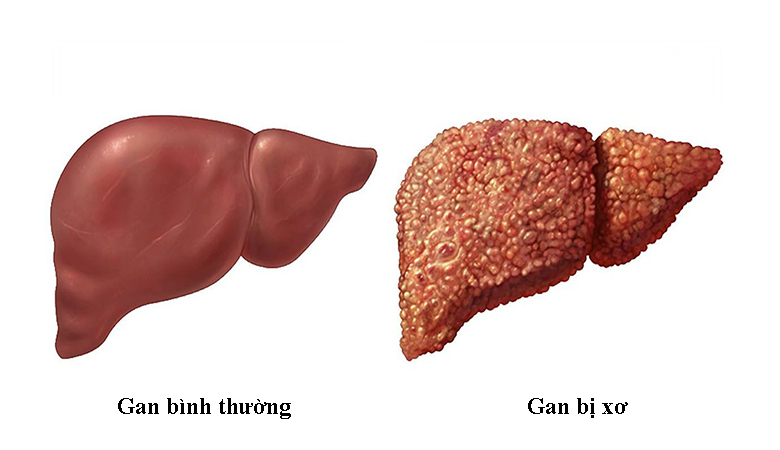 Viêm gan B để lại nhiều hậu quả cho người bệnh như xơ gan, ung thư gan hoặc viêm gan mãn tính, ảnh hưởng sức khỏe và đe dọa đến tính mạng của người mắc bệnh