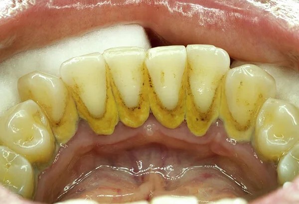 Nên thường xuyên loại bỏ cao răng