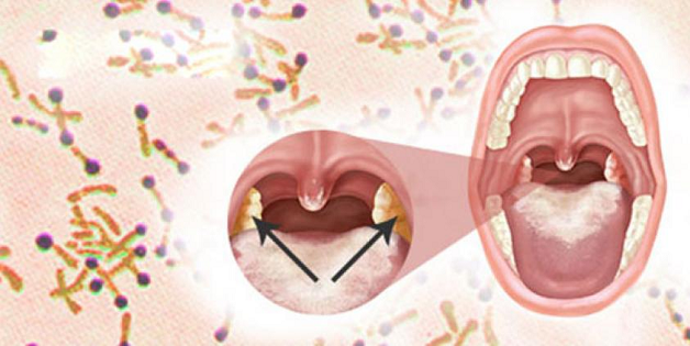 phản ứng sau khi tiêm vacxin phòng bệnh bạch hầu
