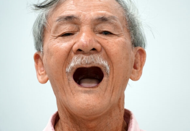 mất 4 răng hàm là gì