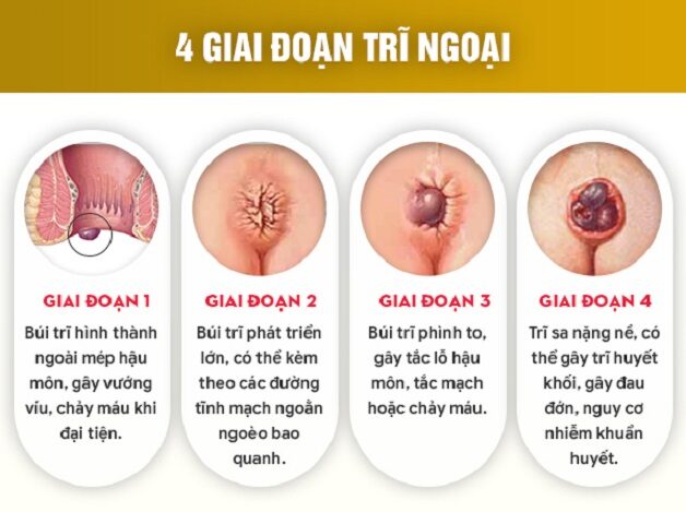 Các cấp độ trĩ ngoại