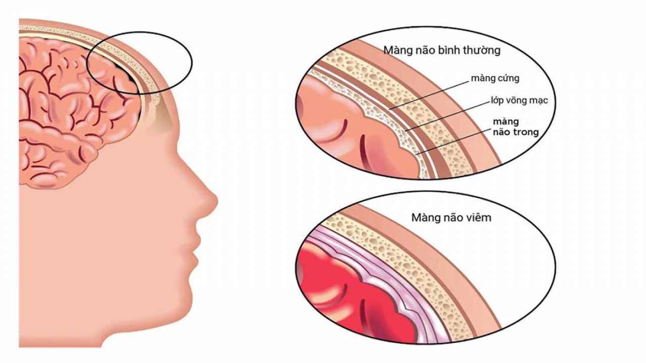 Viêm màng não mủ là tình trạng màng bao bọc quanh hệ thần kinh trung ương bị viêm nhiễm do vi khuẩn xâm nhập
