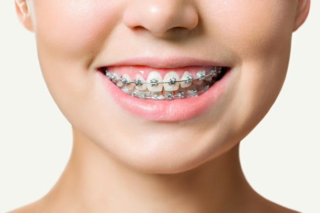 cách chỉnh răng mọc lệch