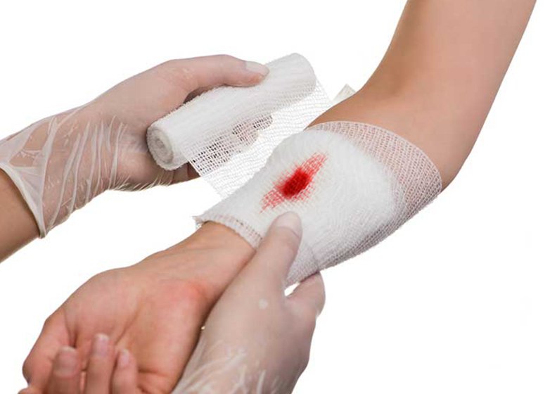 Các vết thương nhẹ hơn như trầy xước da, bị bỏng,... thì vẫn cần tiêm ngừa uốn ván để đảm bảo an toàn
