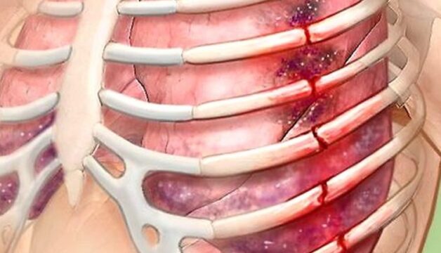 85% các chấn thương ngực dễ biến chứng đến màng phổi.