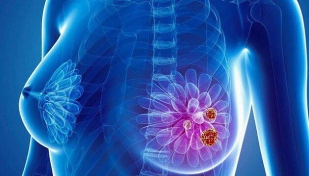Bảng phân loại BIRADS nhằm mục đích chuẩn hóa việc chẩn đoán, tiên lượng nguy cơ ác tính cũng như đưa ra kế hoạch theo dõi, phác đồ điều trị.