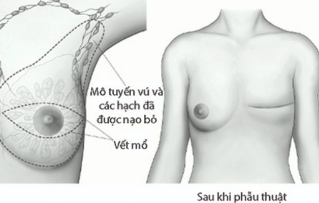 Loại bỏ ung thư vú bằng cách cắt toàn bộ nhu mô tuyến vú, da quanh tổn thương và núm vú, chỉ để lại cơ và da thành ngực.
