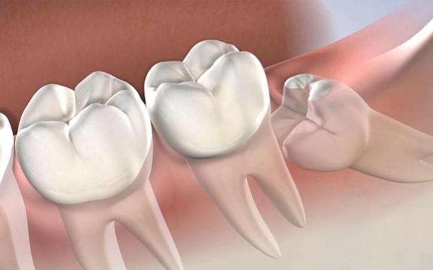 Răng khôn hàm dưới mọc lệch gây ra những cơn đau kéo dài và dễ biến chứng