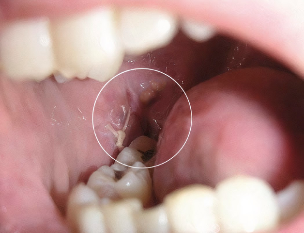 Không phải trường hợp nào cũng nhổ răng khôn không khâu